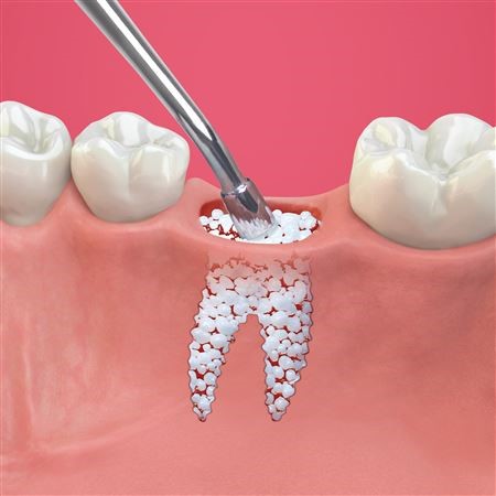 پودر استخوان برای ایمپلنت - Dentanamed