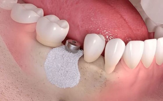 پودر استخوان دندانپزشکی - Dentanamed